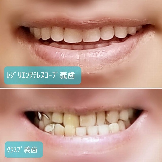 クラスプ義歯とレジリエンツテレスコープ義歯の比較