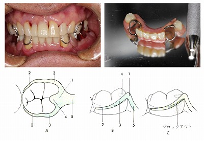 クラスプ義歯.jpg