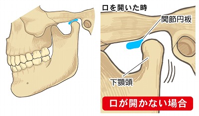 TMJ treatment 002.jpg