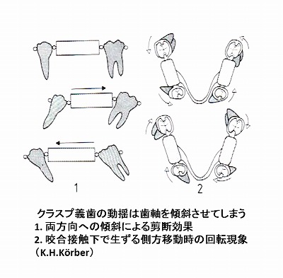 temporary denture K.H.Korber.jpg